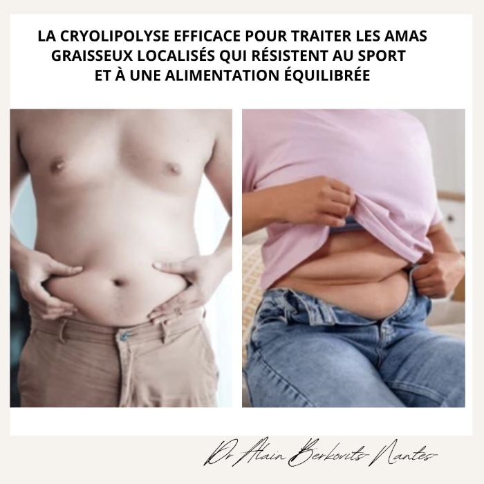La cryolipolyse pour qui ?