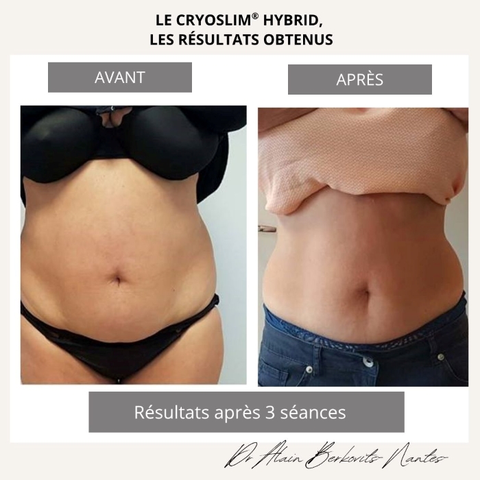 Cryolipolyse avant/après ventre