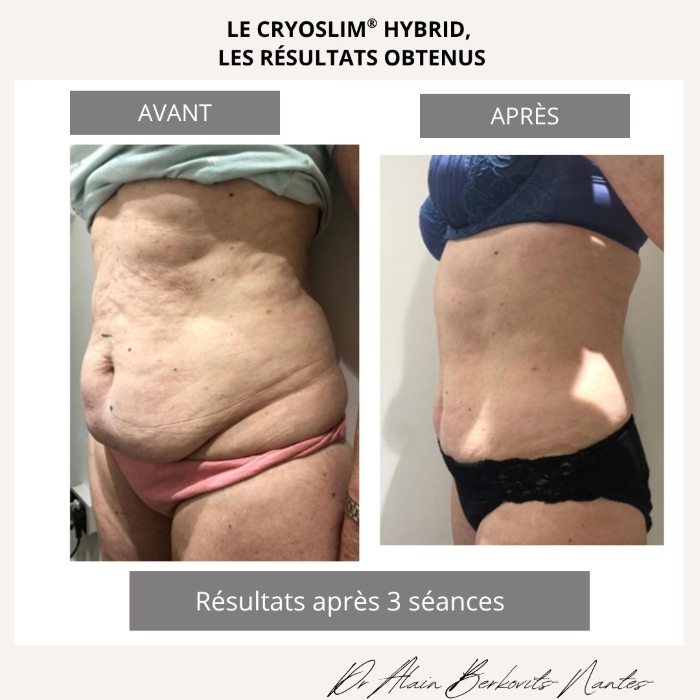 la cryolipolyse : les résultats avant/après