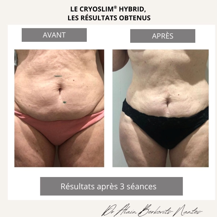 la cryolipolyse : les résultats avant/après