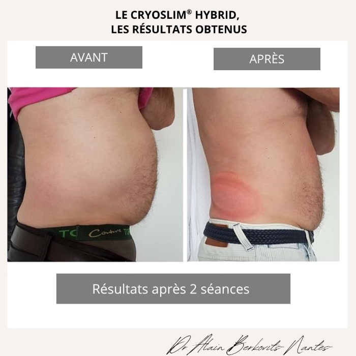 la cryolipolyse : les résultats avant/après