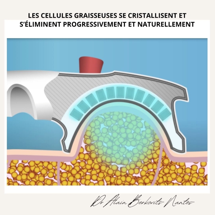 Le principe de la cryolipolyse